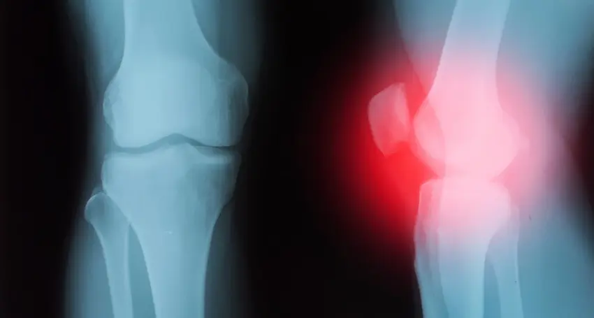 An X-ray is showing a knee fracture injury that may warrant filing a premises liability claim for compensation at the Law Offices of Humberto Izquierdo, Jr. PC.