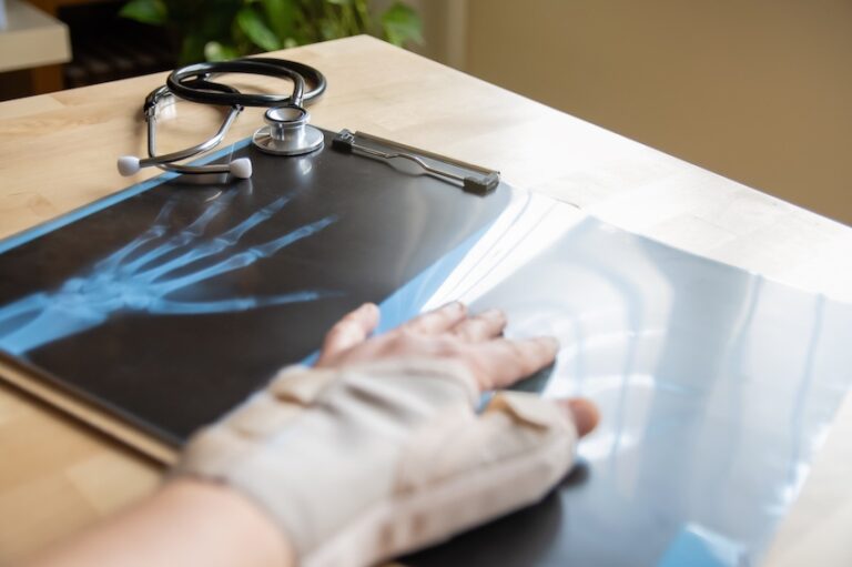 A bandaged hand rests on an X-ray image of a hand beside a stethoscope on a medical desk representing the diagnostic process a workers' comp physician uses to evaluate and document an injured worker's hand injury in Georgia.